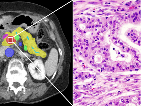 Crossing the boundaries: machine learning for pancreatic cancer across radiology, pathology and genetics (PANCAIM)