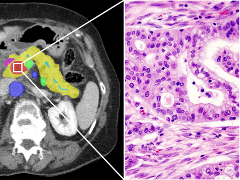 Combining pathological features to predict pancreatic ductal adenocarcinoma survival