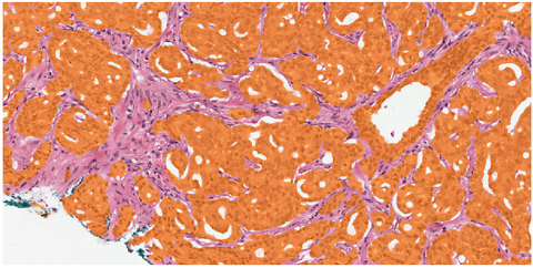 Closing the gap: Implementation of AI-based breast and prostate cancer grading algorithms in clinical practice