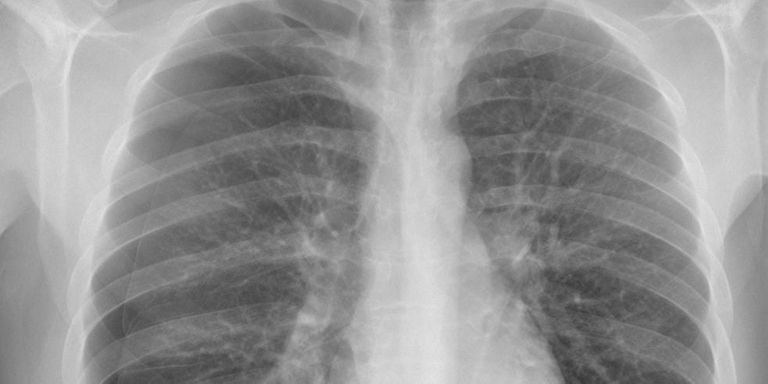 Pneumothorax detection