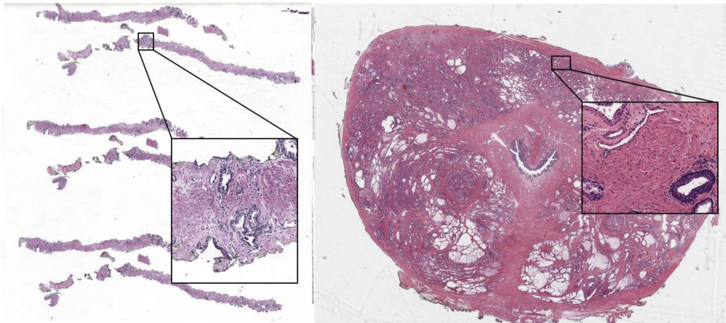 Extending a prostate cancer grading algorithm to other surgical entities