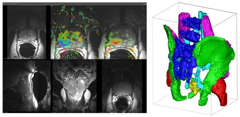Deep learning for Prostate MRI Surveillance