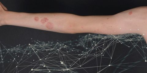 Automated clinical scoring in psoriasis based on RGB images