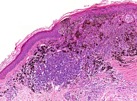 Development and validation of machine-learning based histopathologic skin cancer diagnostics for real-world clinical practice