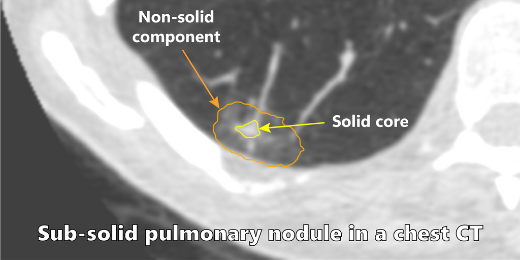 Automatic classification and segmentation of subsolid pulmonary nodules using deep learning