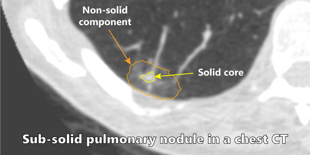 automatic-segmentation-of-subsolid-pulmonary-nodules-using-deep