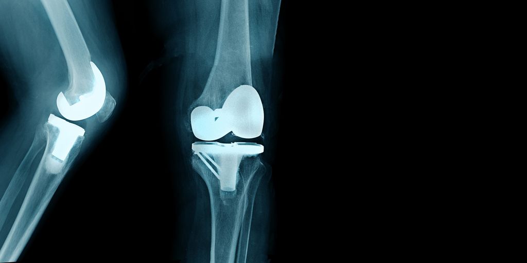 Supervised and unsupervised classification of bone defects in revision total knee arthroplasty