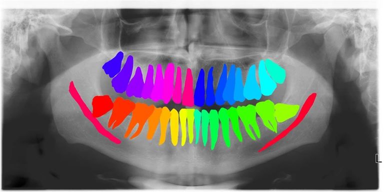 PhD position for development and validation of a deep-learning system for wisdom tooth removal